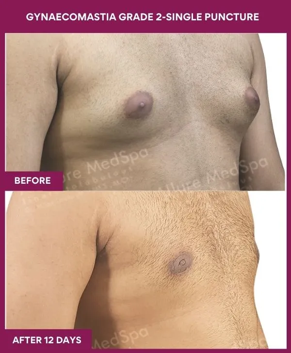 gynecomastia-surgery-grade-2-before-after-results-mumbai-india-patient04-side-right