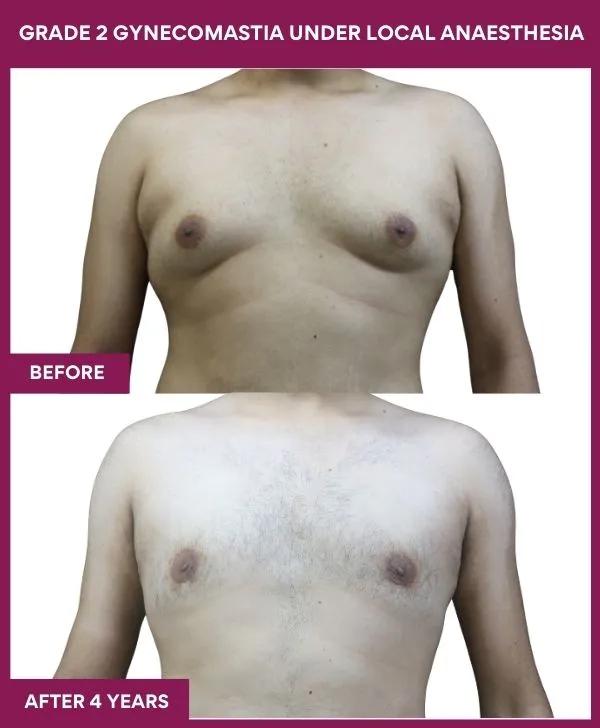 gynecomastia-surgery-grade-2-before-after-results-mumbai-india-patient05-front