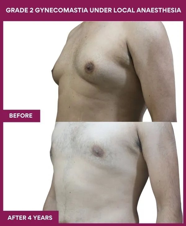 gynecomastia-surgery-grade-2-before-after-results-mumbai-india-patient05-side-left