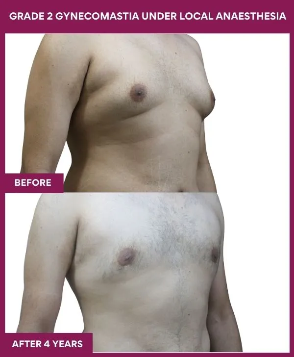 gynecomastia-surgery-grade-2-before-after-results-mumbai-india-patient05-side-right