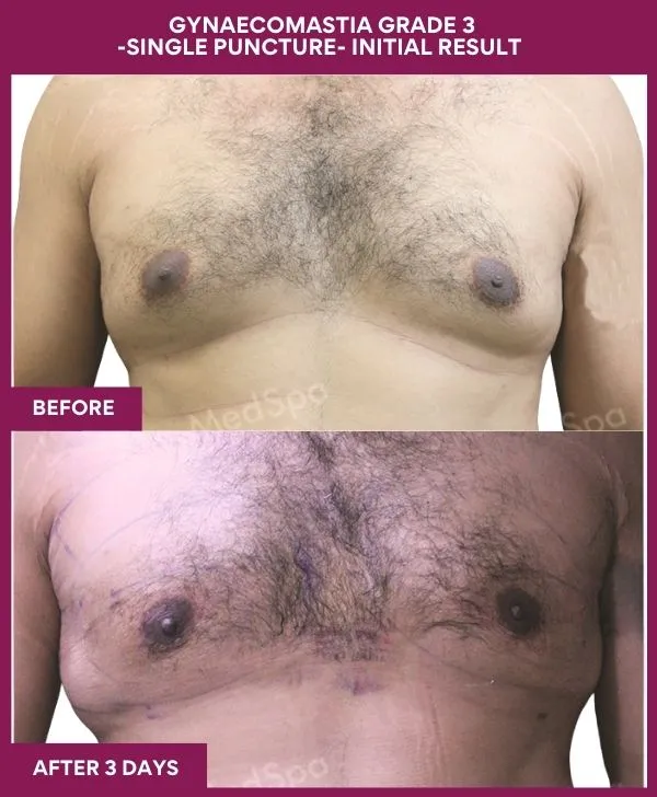 gynecomastia-surgery-grade-3-before-after-results-mumbai-india-patient01-front