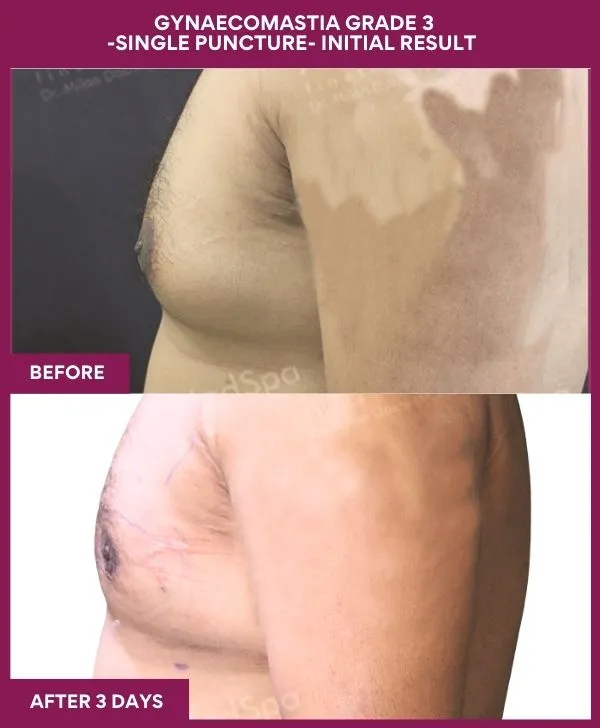 gynecomastia-surgery-grade-3-before-after-results-mumbai-india-patient01-side-left