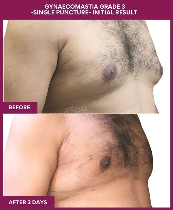 gynecomastia-surgery-grade-3-before-after-results-mumbai-india-patient01-side-right