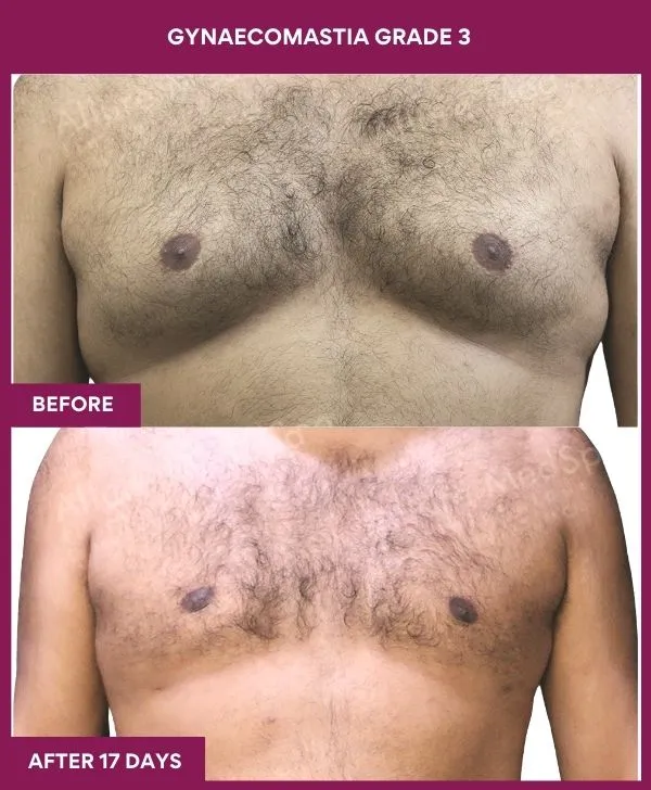 gynecomastia-surgery-grade-3-before-after-results-mumbai-india-patient02-front