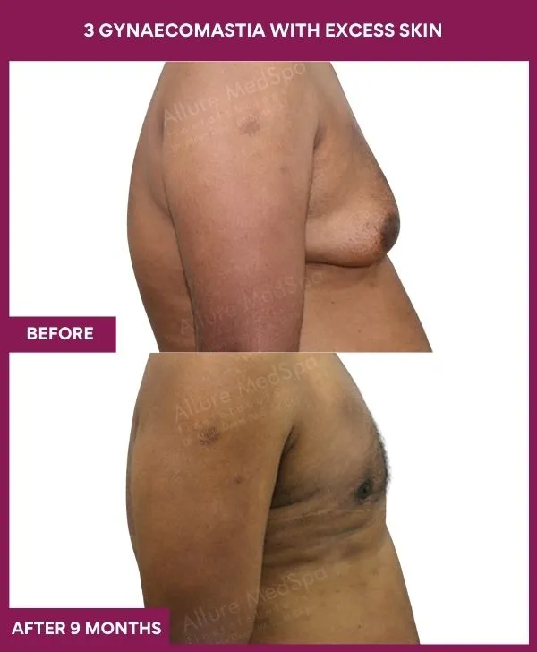 gynecomastia-surgery-grade-3-before-after-results-mumbai-india-patient03-side-right