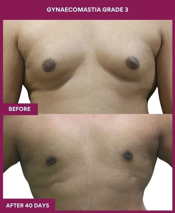 gynecomastia-surgery-grade-3-before-after-results-mumbai-india-patient04-front