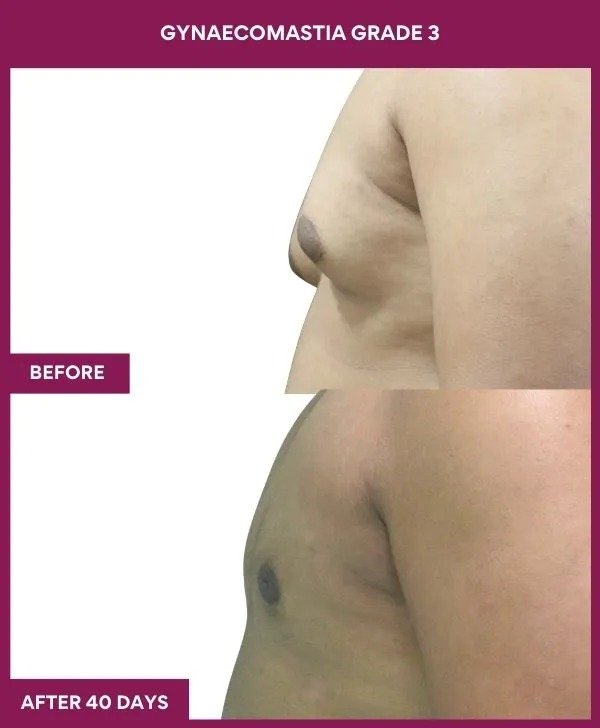 gynecomastia-surgery-grade-3-before-after-results-mumbai-india-patient04-side-left