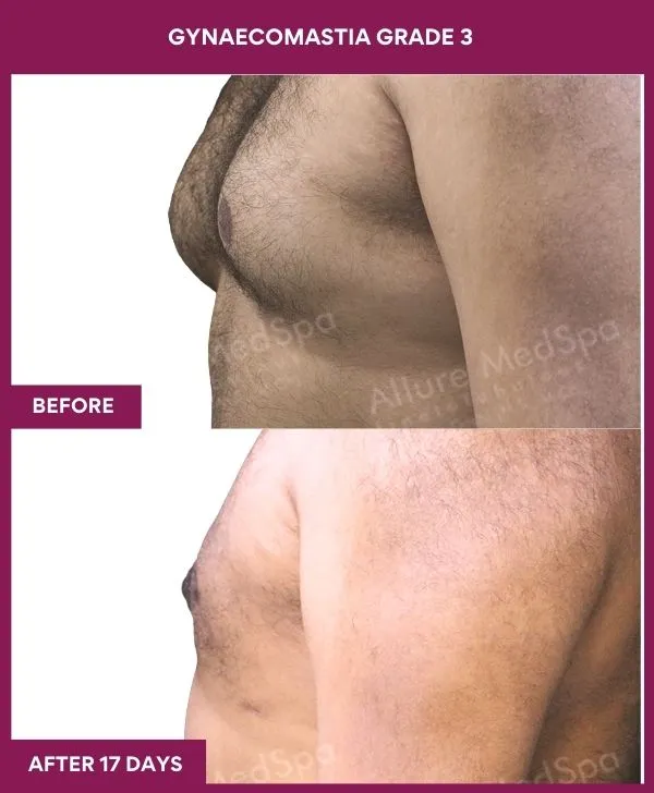 gynecomastia-surgery-grade-3-before-after-results-mumbai-india-patient04-side-left