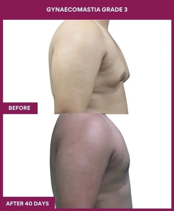 gynecomastia-surgery-grade-3-before-after-results-mumbai-india-patient04-side-right