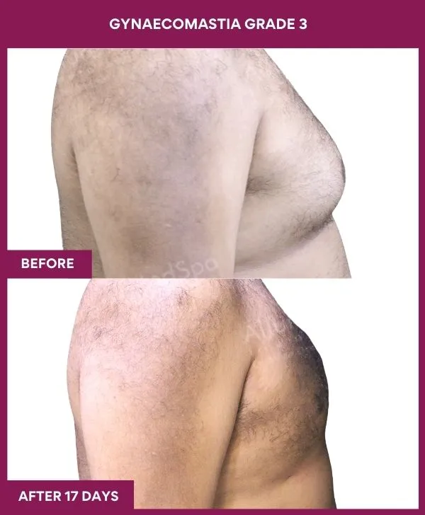 gynecomastia-surgery-grade-3-before-after-results-mumbai-india-patient04-side-right
