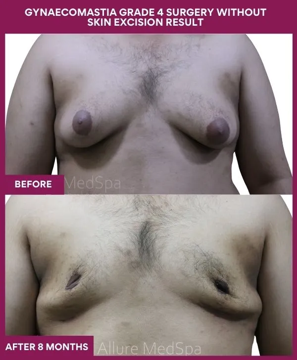 gynecomastia-surgery-grade-4-before-after-results-mumbai-india-patient01-front