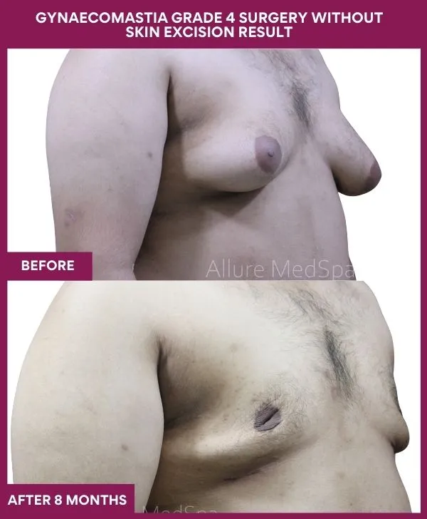 gynecomastia-surgery-grade-4-before-after-results-mumbai-india-patient01-side-right