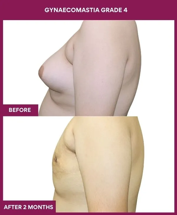 gynecomastia-surgery-grade-4-before-after-results-mumbai-india-patient02-side-left