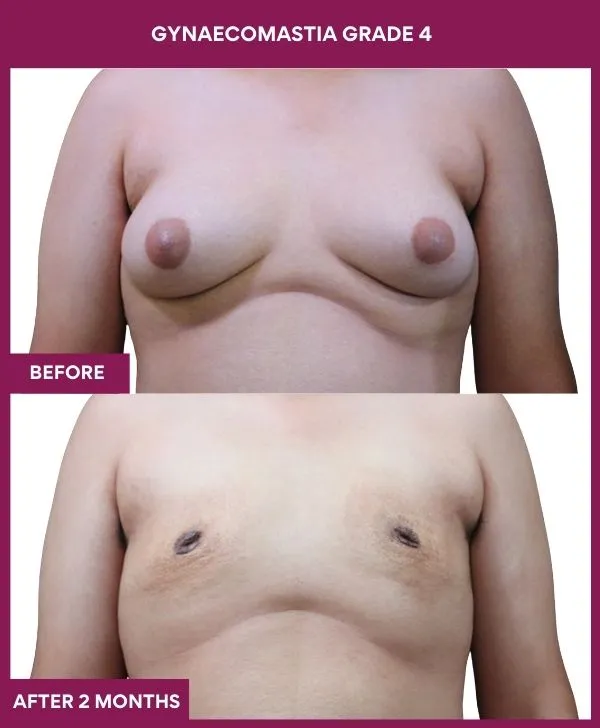 gynecomastia-surgery-grade-4-before-after-results-mumbai-india-patient06-front