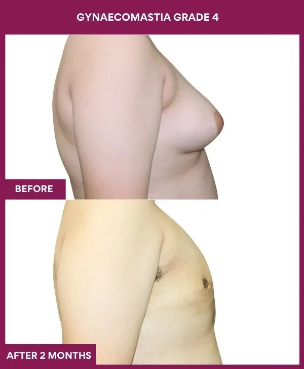 gynecomastia-surgery-grade-4-before-after-results-mumbai-india-patient06-side-right
