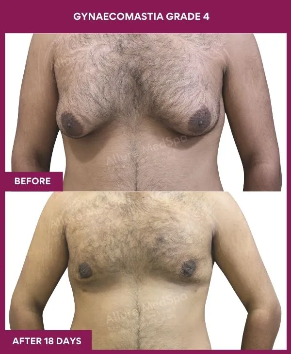 gynecomastia-surgery-grade-4-before-after-results-mumbai-india-patient07-front