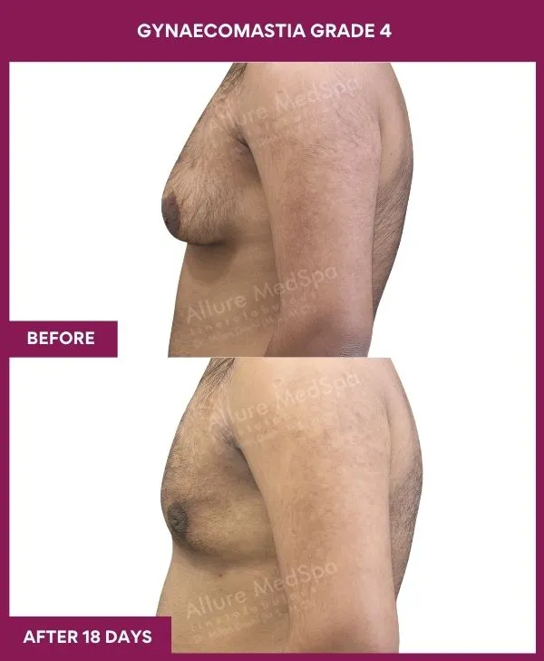 gynecomastia-surgery-grade-4-before-after-results-mumbai-india-patient07-side-left