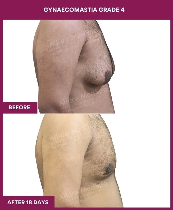 gynecomastia-surgery-grade-4-before-after-results-mumbai-india-patient07-side-right