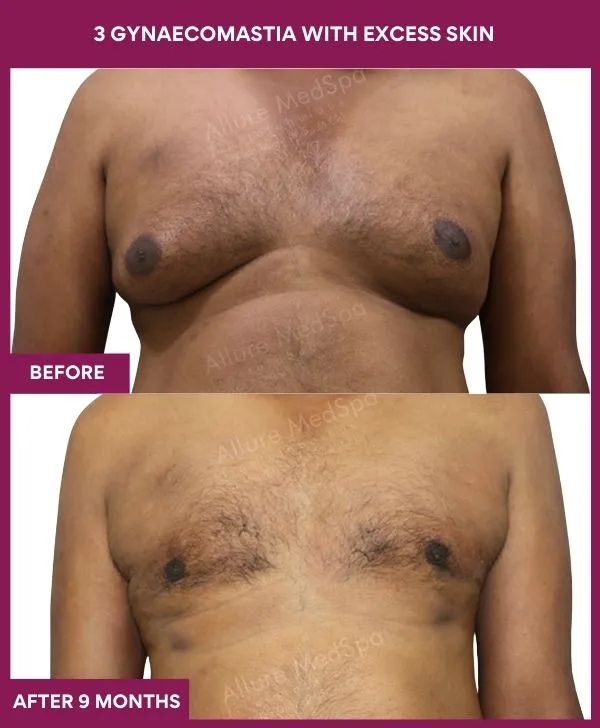 gynecomastia-surgery-with-excess-skin-before-after-results-mumbai-india-patient05-front