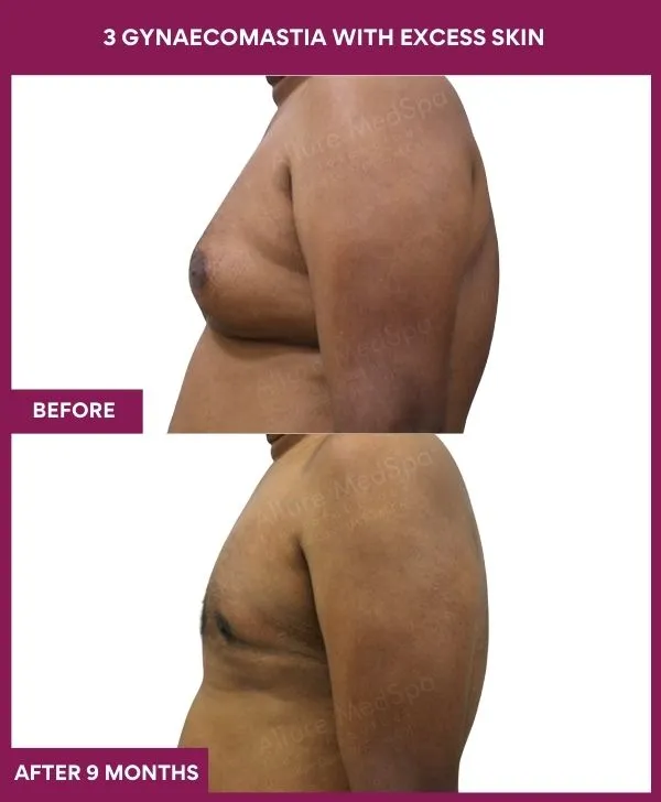 gynecomastia-surgery-with-excess-skin-before-after-results-mumbai-india-patient05-side-left