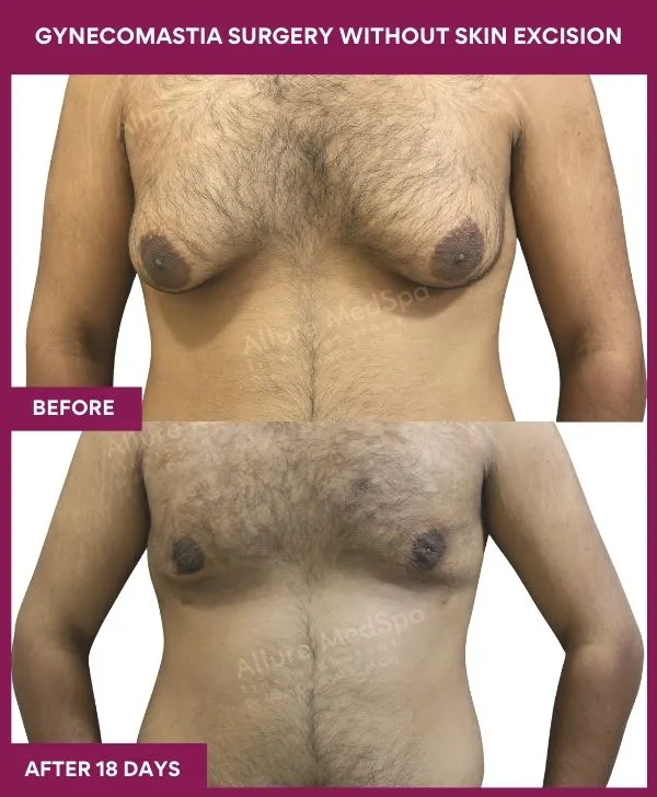 gynecomastia-surgery-without-skin-excision-mumbai-india-patient01-front