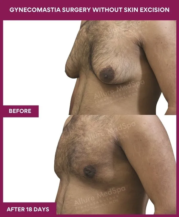 gynecomastia-surgery-without-skin-excision-mumbai-india-patient01-side-left