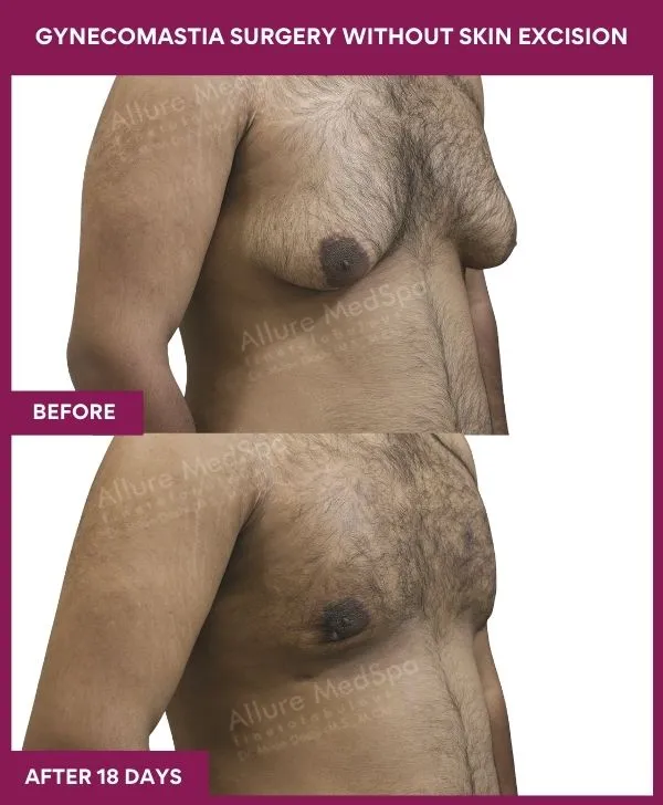 gynecomastia-surgery-without-skin-excision-mumbai-india-patient01-side-right