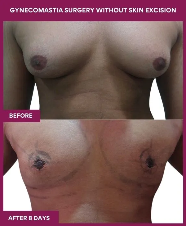 gynecomastia-surgery-without-skin-excision-mumbai-india-patient02-front