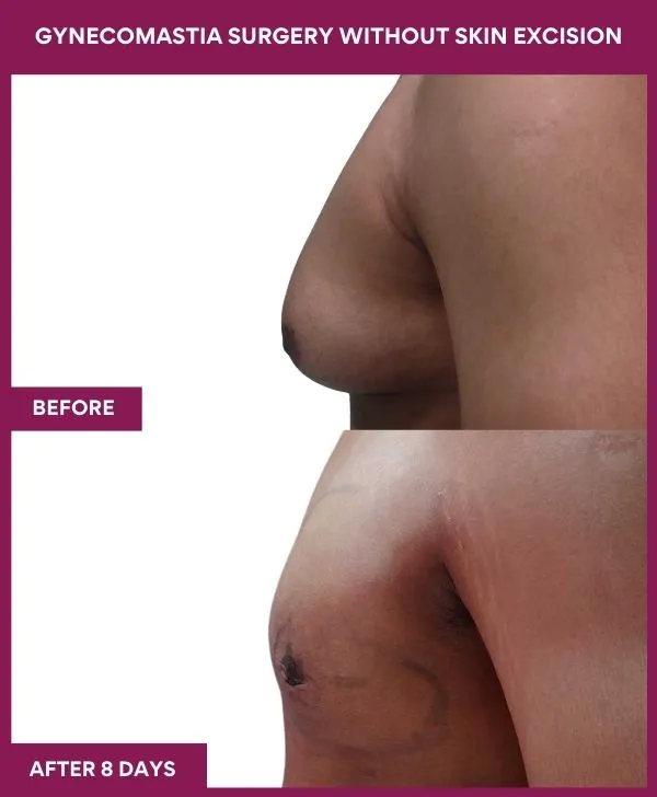 gynecomastia-surgery-without-skin-excision-mumbai-india-patient02-side-left