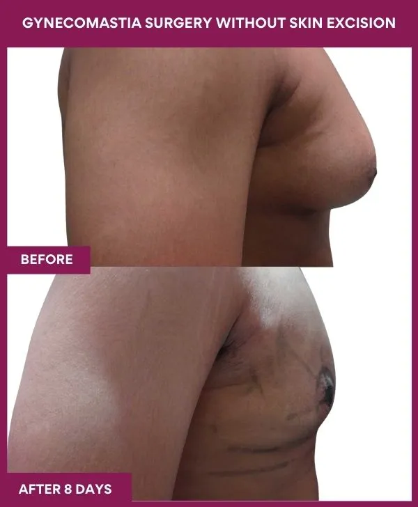 gynecomastia-surgery-without-skin-excision-mumbai-india-patient02-side-right