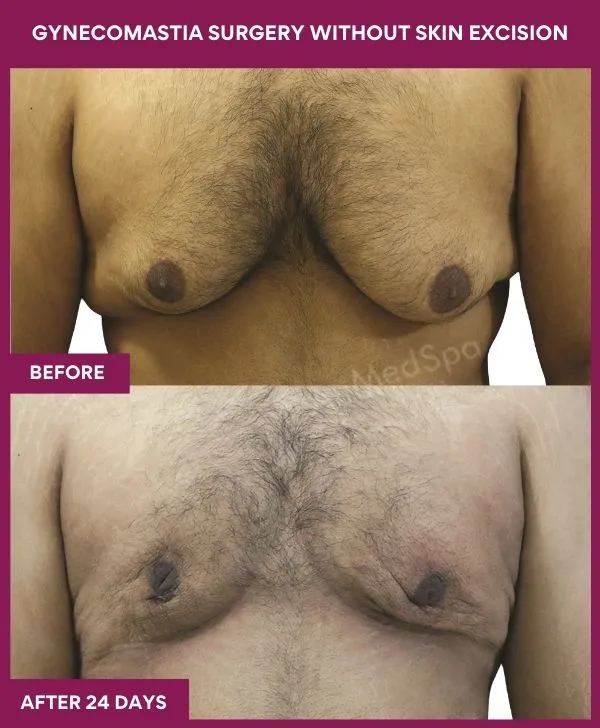 gynecomastia-surgery-without-skin-excision-mumbai-india-patient03-front