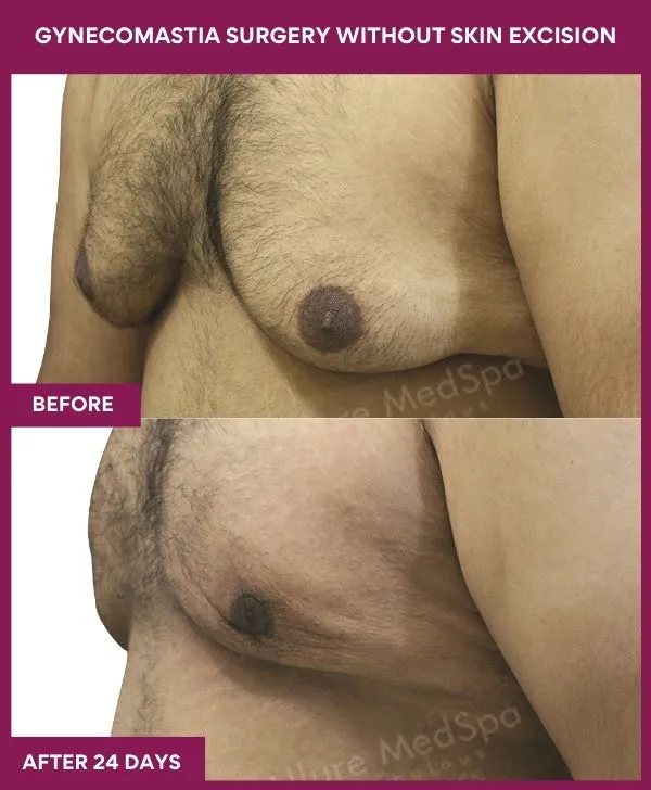 gynecomastia-surgery-without-skin-excision-mumbai-india-patient03-side-left