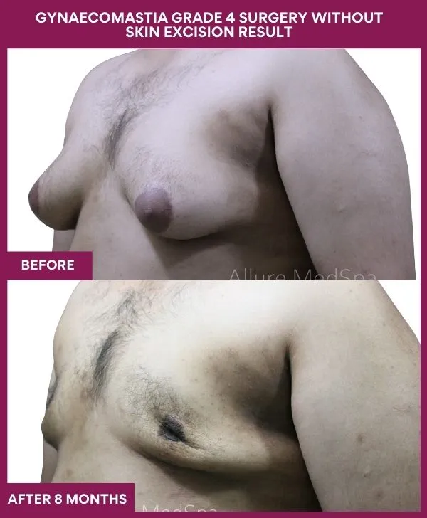 gynecomastia-surgery-without-skin-excision-mumbai-india-patient04-side-left