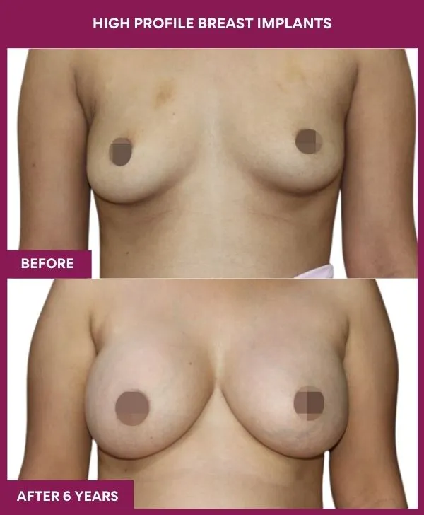 high-profile-breast-implants-before-after-results-mumbai-india-patient01-front