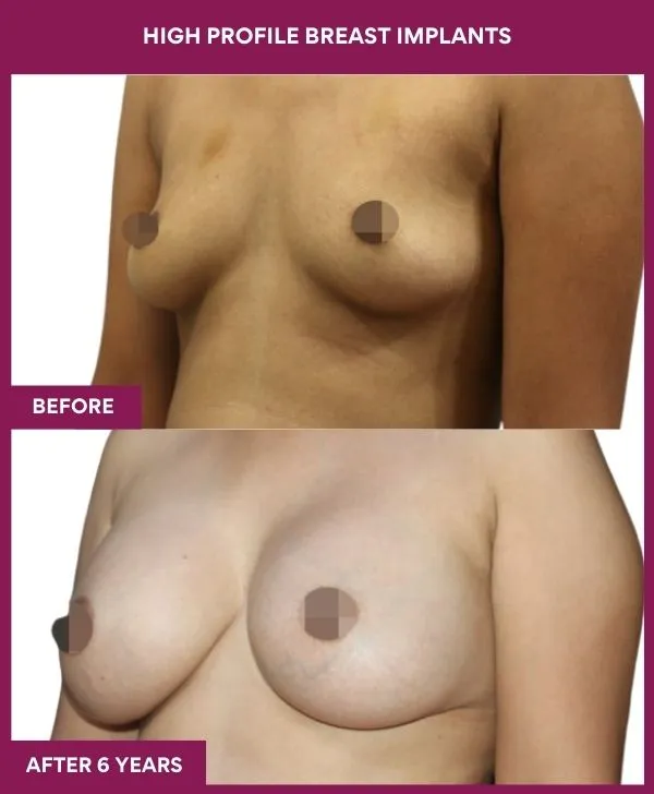 high-profile-breast-implants-before-after-results-mumbai-india-patient01-side-left