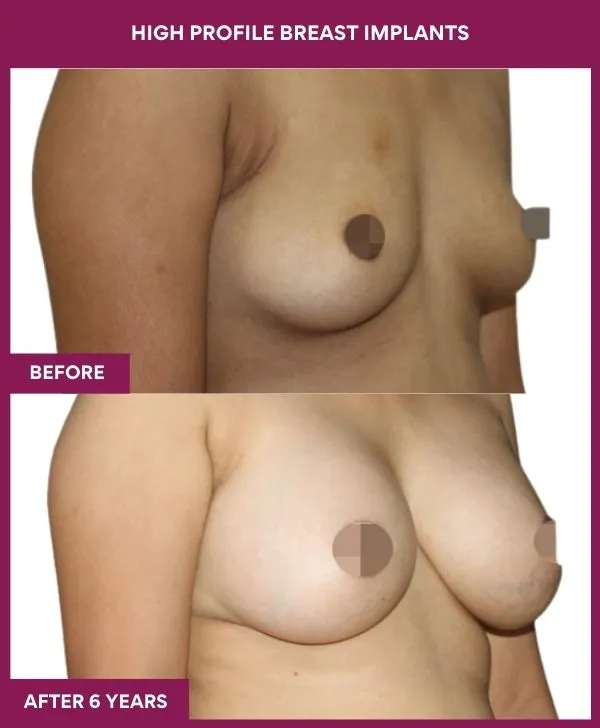 high-profile-breast-implants-before-after-results-mumbai-india-patient01-side-right
