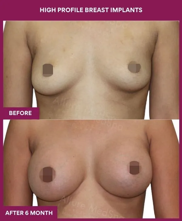 high-profile-breast-implants-before-after-results-mumbai-india-patient02-front