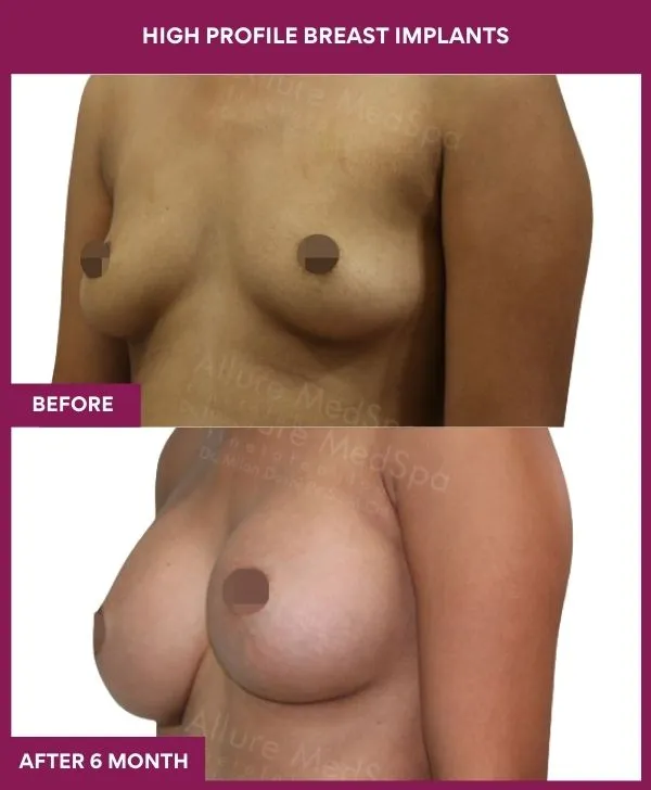 high-profile-breast-implants-before-after-results-mumbai-india-patient02-side-left