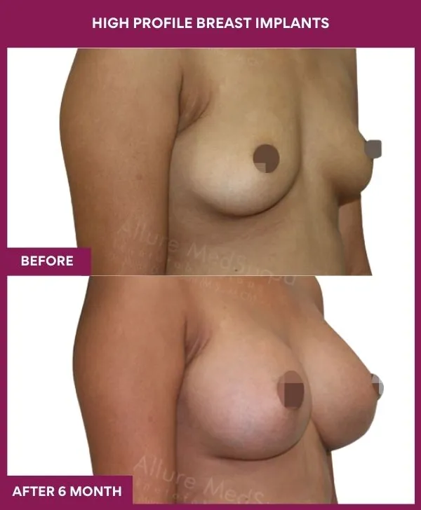 high-profile-breast-implants-before-after-results-mumbai-india-patient02-side-right