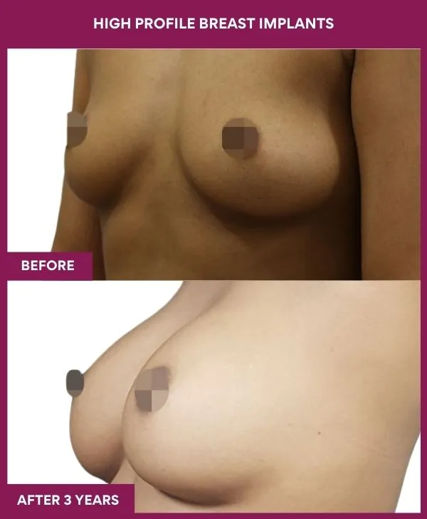 high-profile-breast-implants-before-after-results-mumbai-india-patient03-front-left