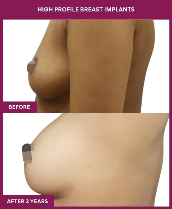 high-profile-breast-implants-before-after-results-mumbai-india-patient03-side-left