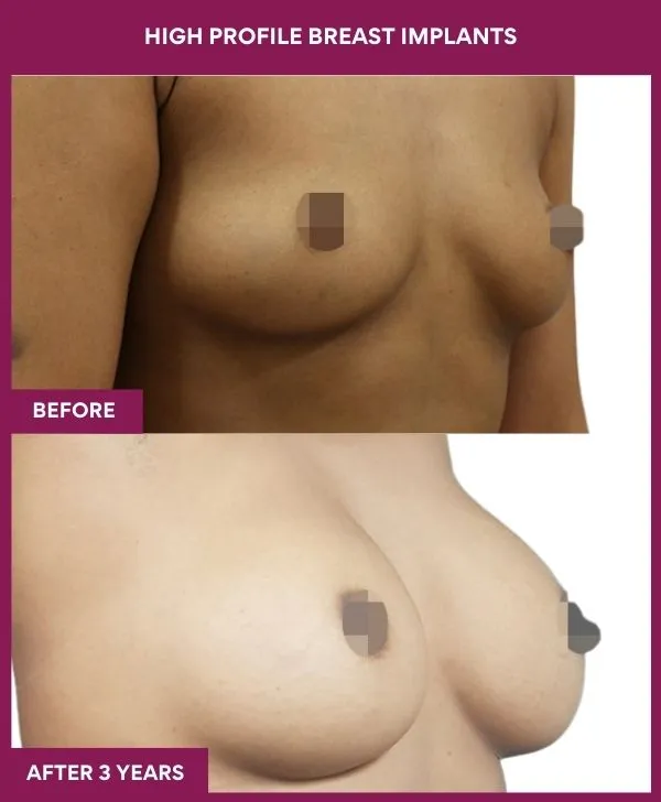 high-profile-breast-implants-before-after-results-mumbai-india-patient03-side-right