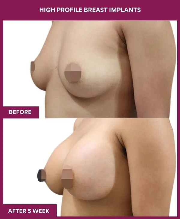 high-profile-breast-implants-before-after-results-mumbai-patient04-front-left