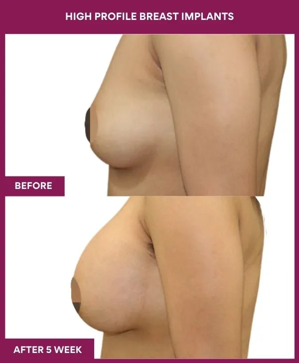 high-profile-breast-implants-before-after-results-mumbai-india-patient04-side-left