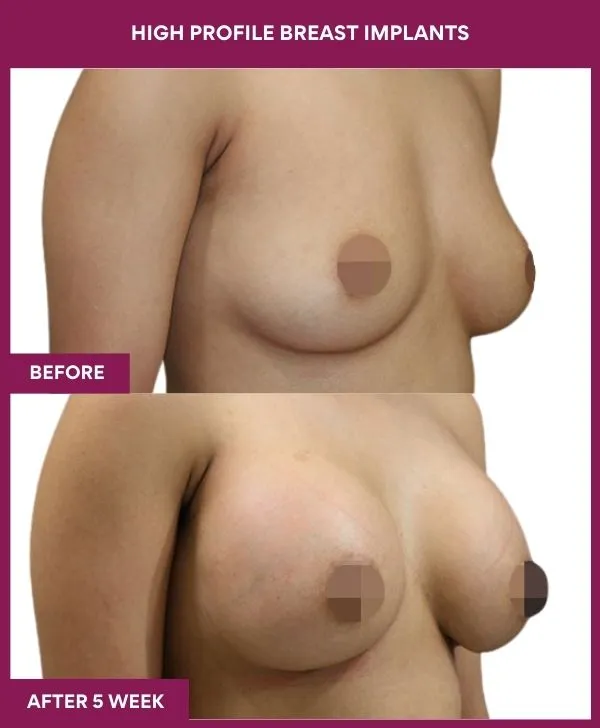high-profile-breast-implants-before-after-results-mumbai-india-patient04-side-right