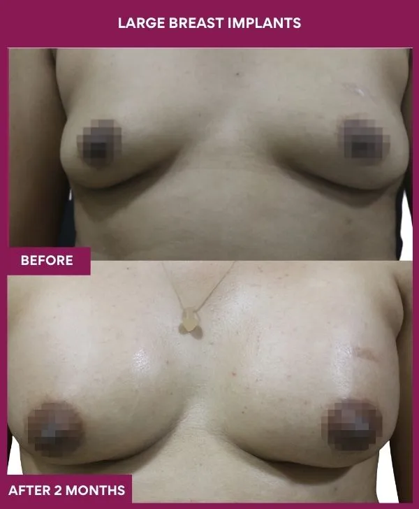 large-breast-implant-before-after-results-mumbai-india-patient01-front