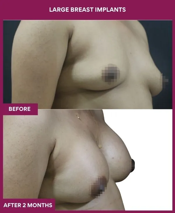 large-breast-implant-before-after-results-mumbai-india-patient01-side-right