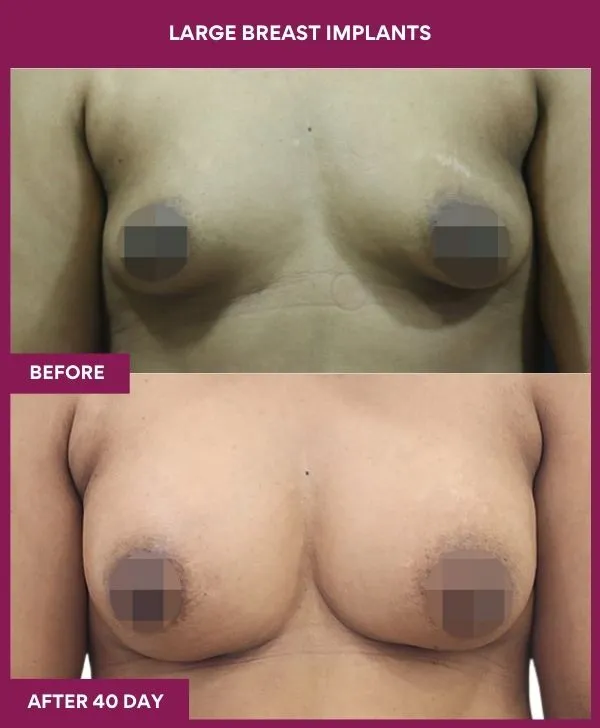 large-breast-implant-before-after-results-mumbai-india-patient02-front