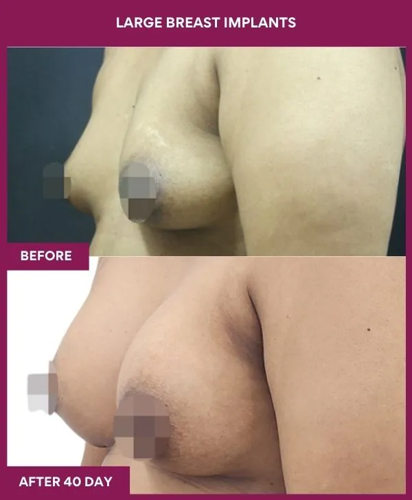 large-breast-implant-before-after-results-mumbai-india-patient02-side-left