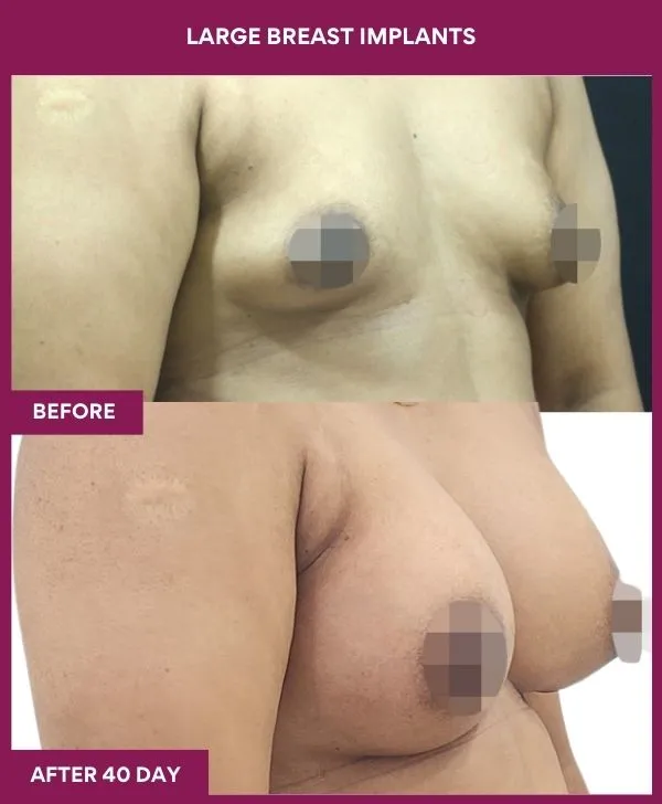 large-breast-implant-before-after-results-mumbai-india-patient02-side-right
